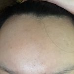 [조언부탁해] 모발 <b>이식</b> 할까 말까ㅠㅠㅠㅠ