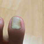 [댓글부탁해] 이거 <b>무좀</b>이야?????