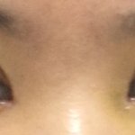 [댓글부탁해] <놀라지마세요!혐주의>쌍수 붓기 짝짝이 ㅠㅠ