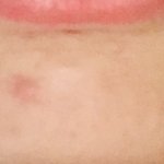 [댓글부탁해] 이거 여드름 <b>치료</b> 하는데 얼마정도 들까?