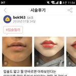 입술<b>필러</b> 미성년자도 맞을수있지??