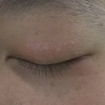 [제발알려줘] 눈두<b>덩이</b>에 두드러기