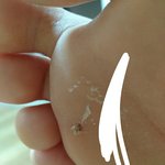 [댓글부탁해] 이거 <b>사마귀</b>맞지?(약혐주의)