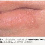 [댓글부탁해] 개학이 코앞인데 입술에 <b>물집</b>남ㅜㅜ