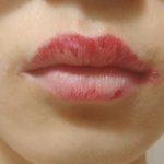 [조언부탁해] <b>입술</b> 뜯는거 어떻게 고치냐(추가(사진 혐 주의
