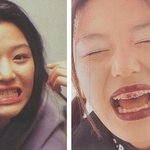 [맹꽁이눈] 박기량<b>눈꺼풀</b>