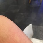 [방탈죄송] 극장에서 영화보다가 모기 10군데도 더 물렸어요