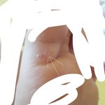 [조금혐주의] 발에 <b>물집</b>난게 어쩌냐....