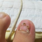 [댓글부탁해] <b>발톱</b>빠졌다는 쓰닌데 발가락 이렇게 됐어
