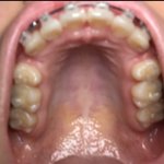 [댓글부탁해] 교정 <b>발치공간</b> 이정도 남았는데 이번년도안에