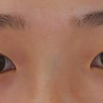 [조언부탁] 언더 <b>래쉬</b> 어떻게 해야 하나요 ㅠㅠ (사진첨부)