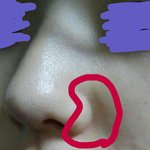 <b>코옆</b> 피부관리 어떡하냐ㅜㅜ