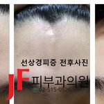 <b>선상</b>경피증 치료될수 있다.~