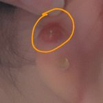 귀 뚫은 곳 <b>염증</b>