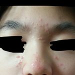 [약혐주의] 여드름 박살내는법 알려줌