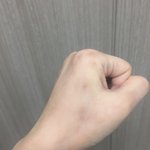 [댓글부탁해] 이런 모기흉터 안없어져??