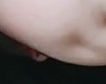 <b>보조개</b> 없애는 <b>수술</b> 해라 vs하지마라 (사진ㅇ)