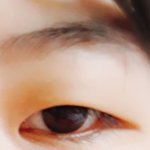 안검<b>하수</b> 수술 할까 말까