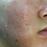 [조언부탁해] 혐주의 피부 잘아는 얘들아 데발 도와줘ㅠㅠ