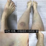 [드루와] 구하라 멍이랑 진단서 보고가