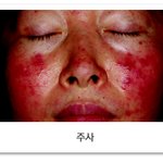 [댓글부탁해] 피부때문에 정말 죽을거같아