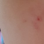 [조언부탁해] 사진 혐)얘들아 <b>블렉헤드</b> 구멍 어캄