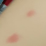 [댓글부탁해] 이거 개미 물린 <b>자국</b>일까?? ㅠㅠ