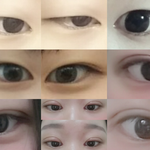 쌍수 9달차의 쌍수후기