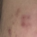 [조언부탁해] 애들아 <b>좁쌀</b>여드름 어떻게해야해??(약혐)