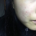 이거 여드름 <b>흉터</b> 어떻게 없애 ㅠ 도와줘