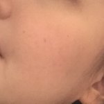 여드름 약(이소티논)후기