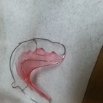 [EXO] 교정기 드디어뺐는데 유지장치 덫에 걸렸다