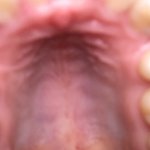 [댓글부탁해] 교정끝난애들아 나 <b>발치공간</b>몇달이면닫힐까?