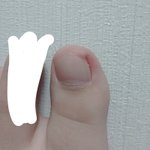 [드루와] 약혐) <b>내성</b>발톱깎다가 지옥맞봄