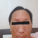 [도와주세요] 한의원 잘못갔다가 얼굴이 망가젔어요