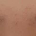 [댓글부탁해] (약혐주의( 미간 <b>좁쌀</b>여드름 원인이 뭘까ㅠㅠㅜ