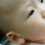 만명중 세명 나타난다는 오타모반이 저희 아기에게.. 전 어떻게 해야할까요...