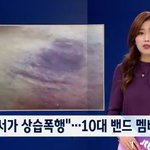 [드루와] 뉴스에 나온 더이스트라이트 멤버 <b>상처</b> 사진