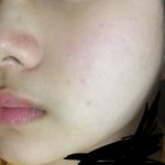 [댓글부탁해] 피부 <b>개지랄남</b>ㅡㅡ