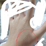 [댓글부탁해] <b>개</b>급해) 얘들아 나 <b>손</b> 텄었는데 이거 뭘까 ㅜㅜ