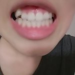 나같은<b>덧니</b>있어?