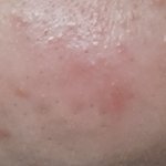 [댓글부탁해] 붉은여드름 아는사람?..<b>사진O</b>