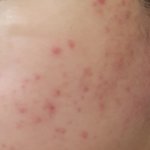[조언부탁해] 얘들아 나 피부가 너무 심해졌어 ㅠㅠ