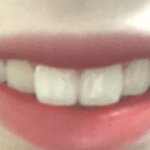 사진0) 나 <b>앞니</b>만 교정할까 ?