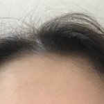 [조언부탁해] <b>헤어</b>라인 제발 도와줘ㅠㅜㅜㅜㅜ
