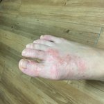 발등 피부좀 봐주세여ㅠㅠㅜㅜㅜ(<b>방탈</b>)