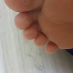 사진) 사마귀랑 티눈 구별할줄 아는사람 있어?