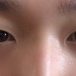 쌍수할건데 앞트임하면 어떨거같아?ㄴㅈ