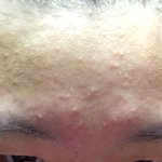 [댓글부탁해] 여드름때문에 죽고싶다,,,