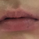 환절기만 되면 입술 이렇게 트는 거 정상임?